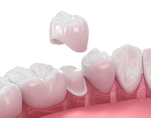 A graphic image showing dental crown in Wahroonga, NWS