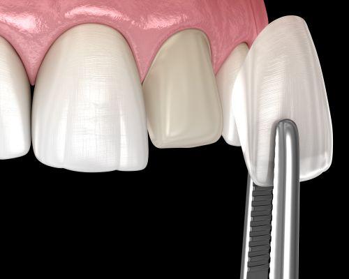 An graphic image depicting Veneers In Wahroonga, NWS