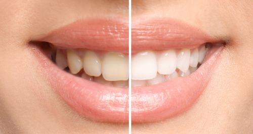 Two images showing teeth whitening before and after results in Wahroonga, NWS