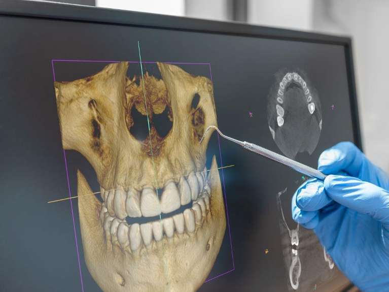 An image of teeth shown with a CBCT Cone Beam Technology in Wahroonga
