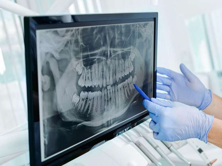 An image of teeth shown using Panoramic X-Rays in Wahroonga